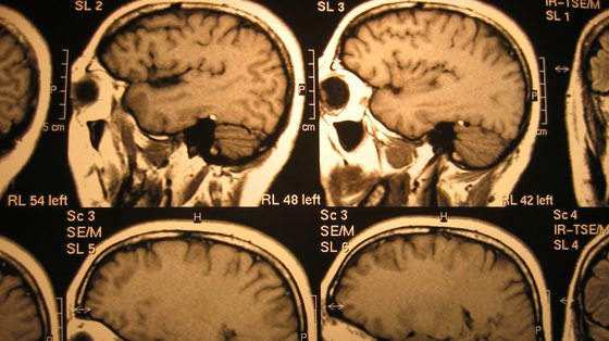 Chorzy na padaczkę bardziej podatni na guza mózgu