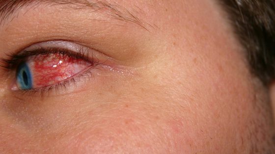Lek do przemywania oczu pomoże uniknąć objawów wirusowego zapalenia spojówek