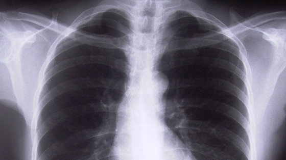Rak płuc: nowy test oddechowy